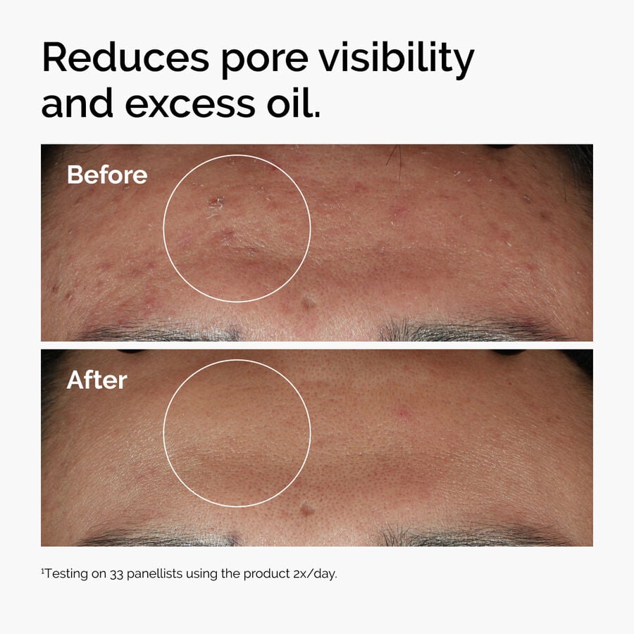 niacinamide-10-zinc-1-z2 ord-niacinamide-zinc-blemish-serum-before-after-pores.jpg