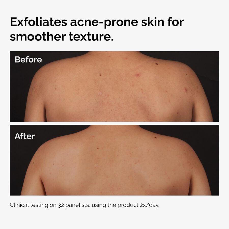 the-body-care-collection-q0 ord-salicylic-acid-body-serum-before-after-graphic-NA.jpg