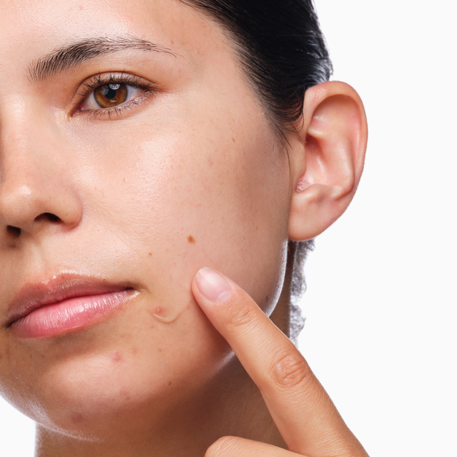 the-acne-set-o3 rdn-the-acne-set-application.png